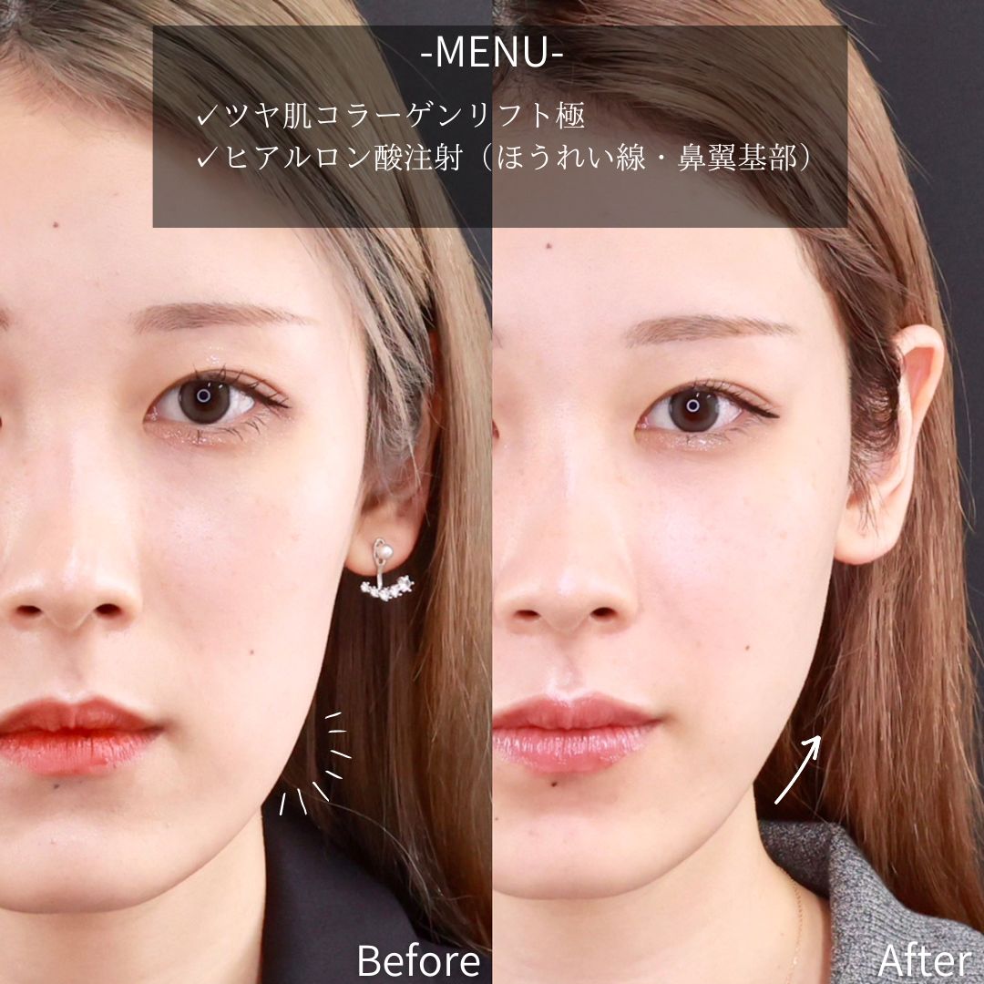 TAC式 ツヤ肌コラーゲンリフト®/ほうれい線のヒアルロン酸注射の症例写真 施術前後 