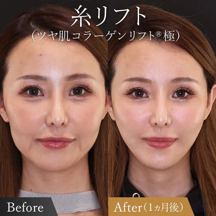 糸リフトは意味がない？金ドブといわれる理由とは？