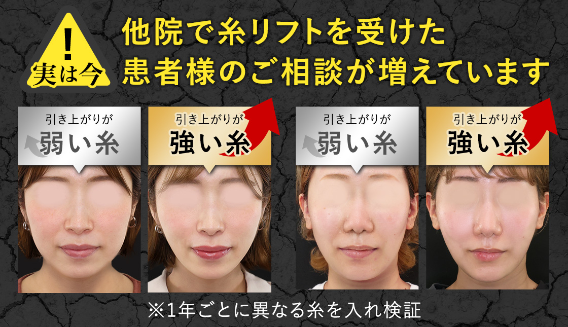 他院で糸リフトを受けた患者様のご相談が増えています