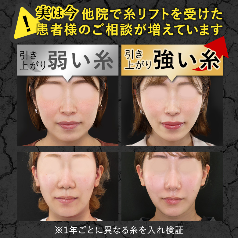 他院で糸リフトを受けた患者様のご相談が増えています