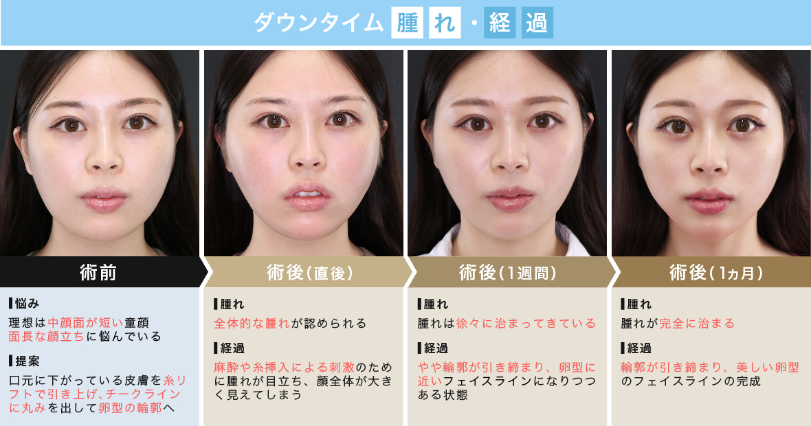 糸リフトのダウンタイムは?