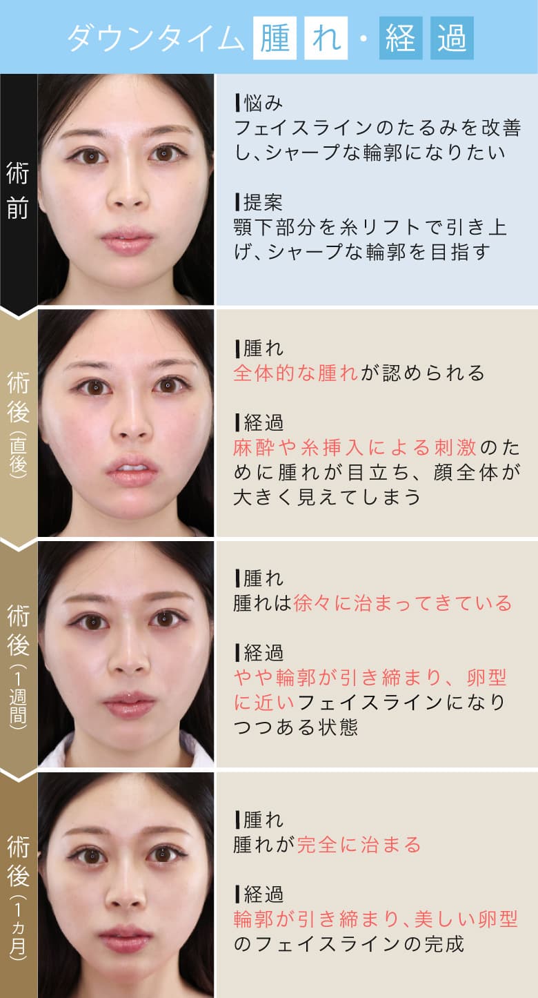 糸リフトのダウンタイムは?