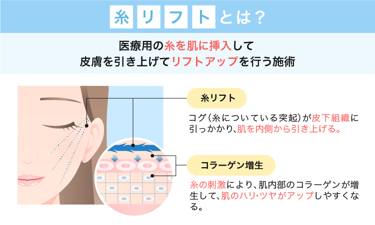 糸リフトとは