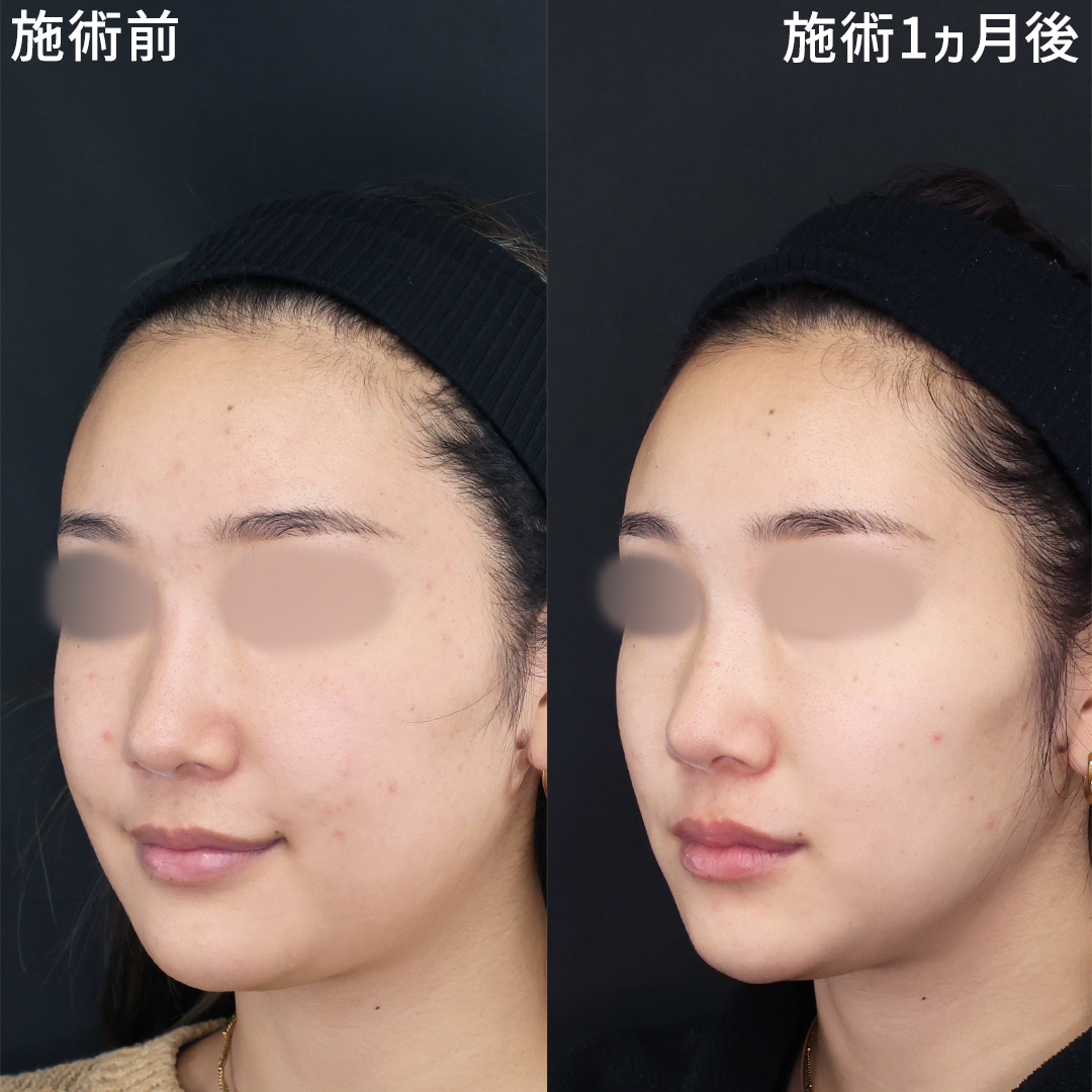 気になるフェイスラインのもたつきを撃退！【小顔糸リフト】