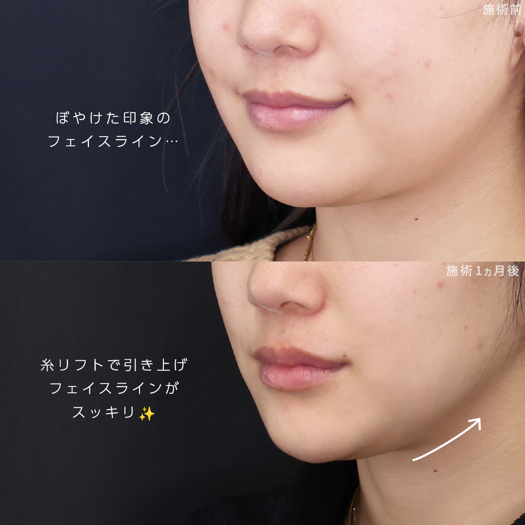 TAC式 ツヤ肌コラーゲンリフト®/TAC式 ショッピングリフト/エラボトックス注射の症例写真 施術前後 