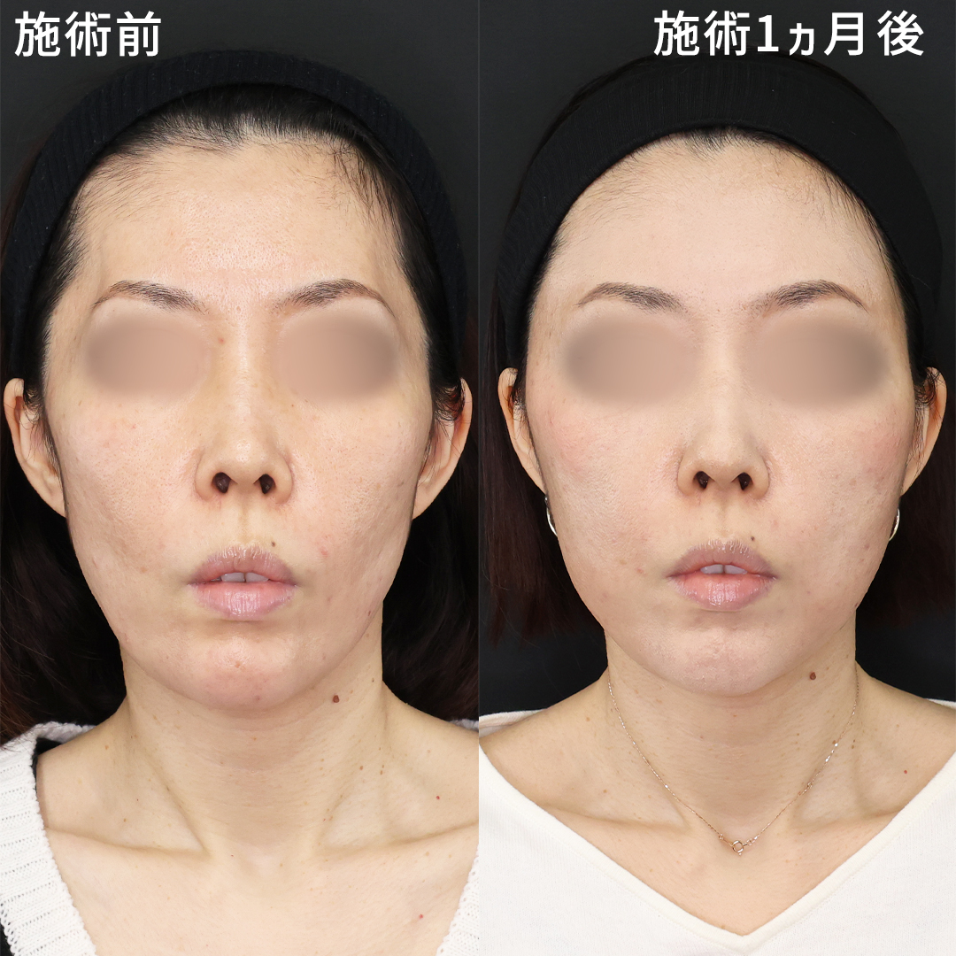 頬コケ改善で見た目年齢マイナス5歳！【脂肪注入×エイジングケア】