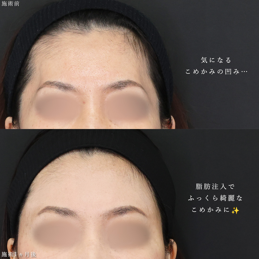 TAC式 ツヤ肌コラーゲンリフト®/TAC式 ショッピングリフト/顔の脂肪注入(コンデンスリッチフェイス)の症例写真 施術前後 