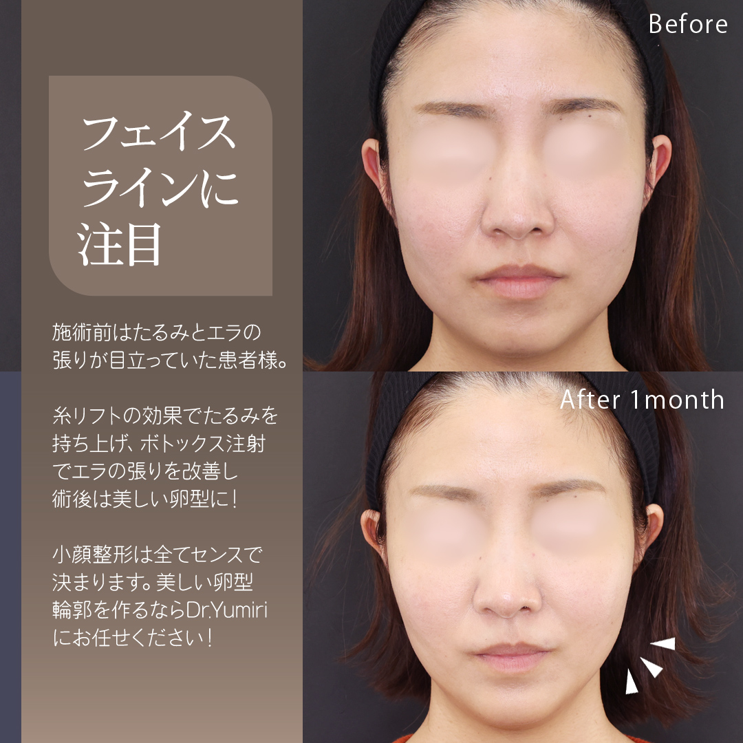 TAC式 ツヤ肌コラーゲンリフト®/エラボトックス注射/ボトックス注射:その他の症例写真 施術前後
