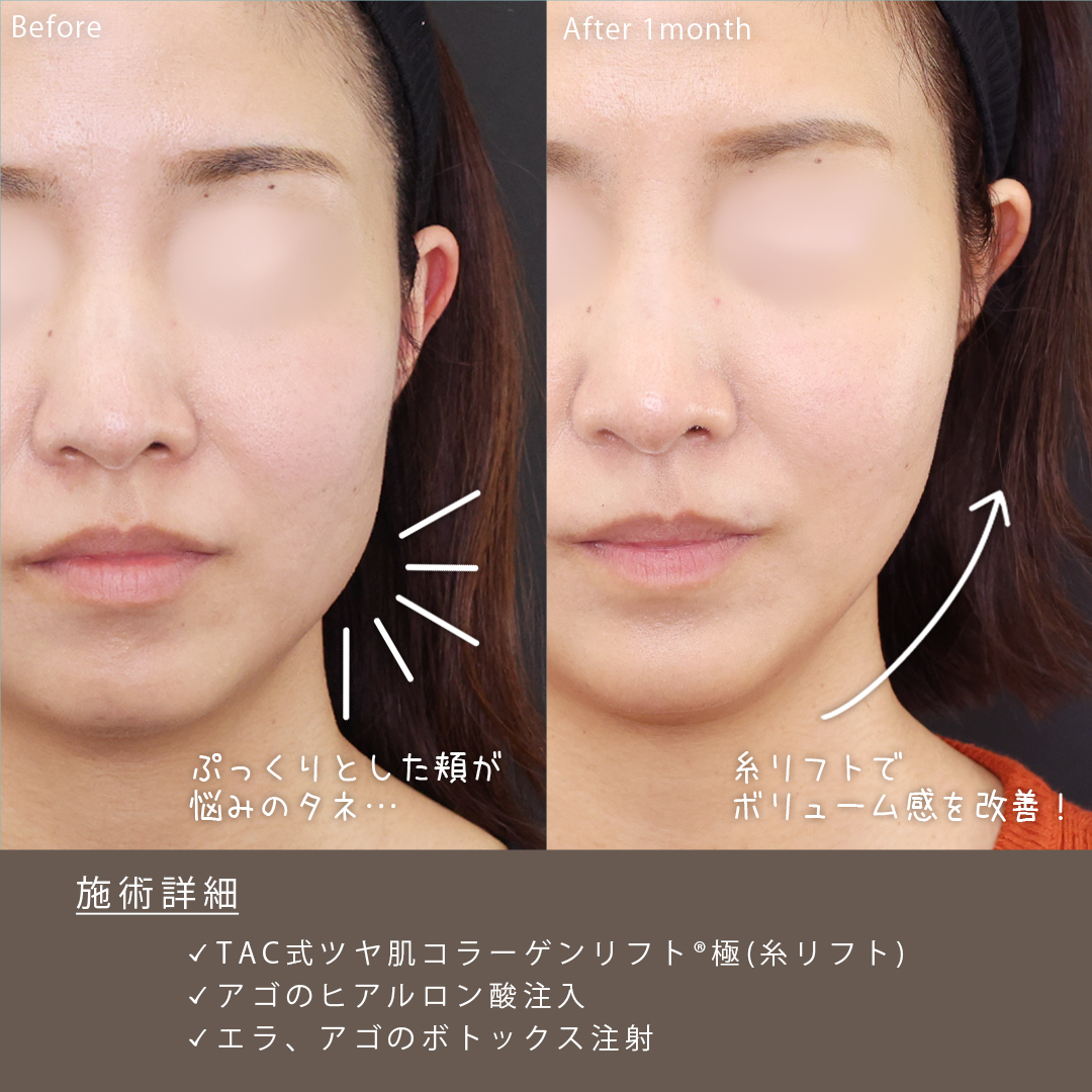 TAC式 ツヤ肌コラーゲンリフト®/エラボトックス注射/ボトックス注射:その他の症例写真 施術前後