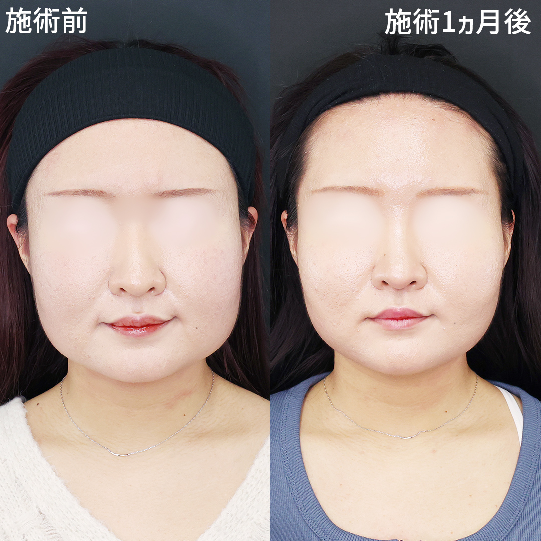 小顔整形でお顔をひと回り小さく！垢抜け小顔術✨