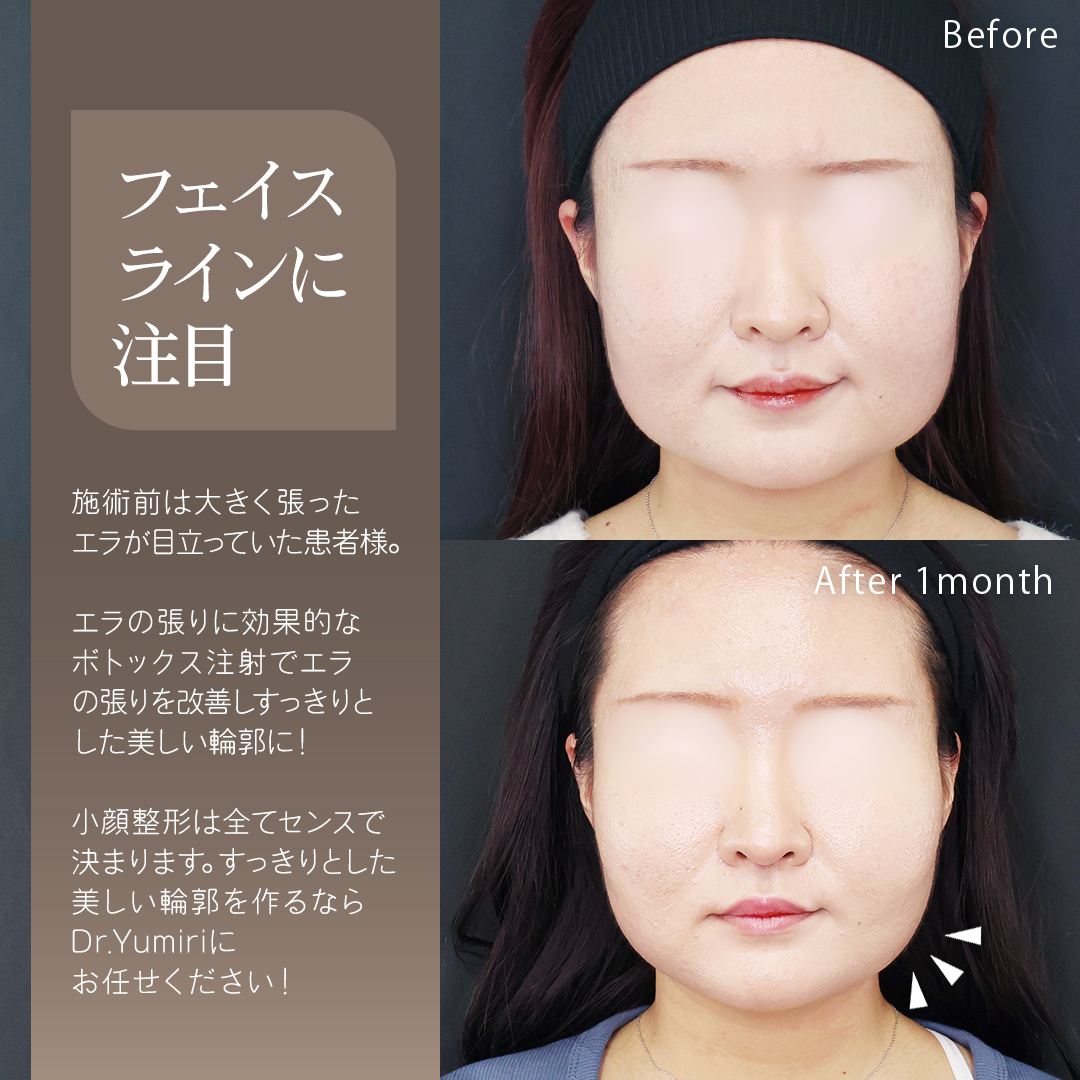 TAC式 ツヤ肌コラーゲンリフト®/ジョールファット除去/おでこボトックス注射の症例写真 施術前後 