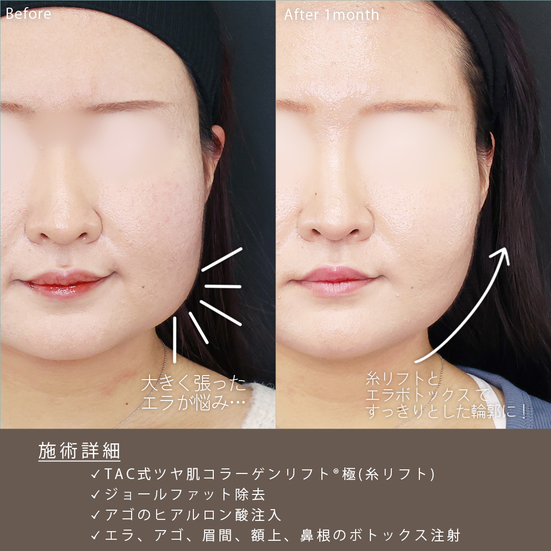 TAC式 ツヤ肌コラーゲンリフト®/ジョールファット除去/おでこボトックス注射の症例写真 施術前後 