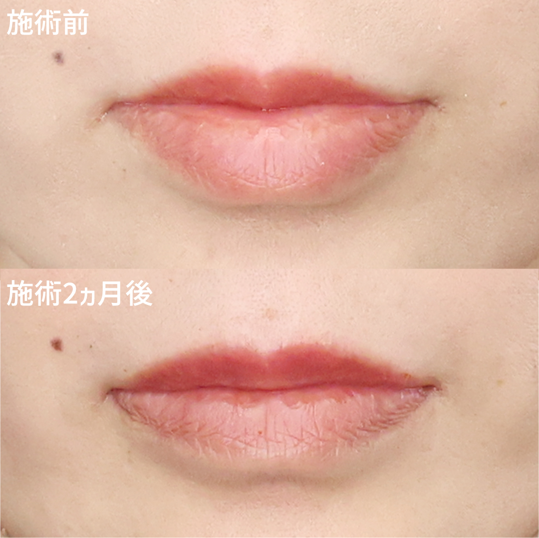 スマイルリップで唇の形を整える【唇ヒアルロン酸注射+口角ボトックス】