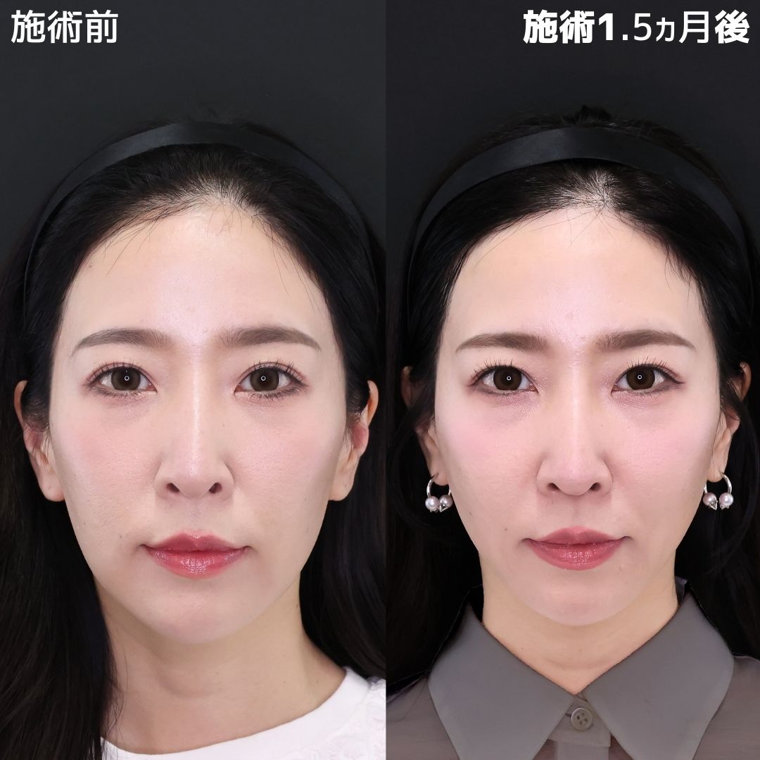 【糸リフト×脂肪除去】たるみ0で若返り！小顔を極めるならDr.古川まで