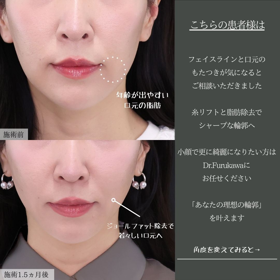 ジョールファット除去/TAC式 ツヤ肌コラーゲンリフト®/ボトックス注射：その他の症例写真 施術前後 