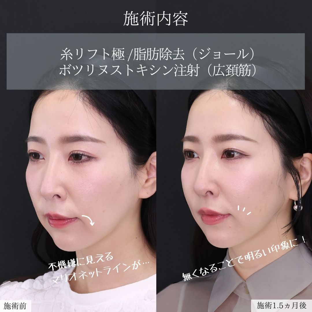 ジョールファット除去/TAC式 ツヤ肌コラーゲンリフト®/ボトックス注射：その他の症例写真 施術前後 