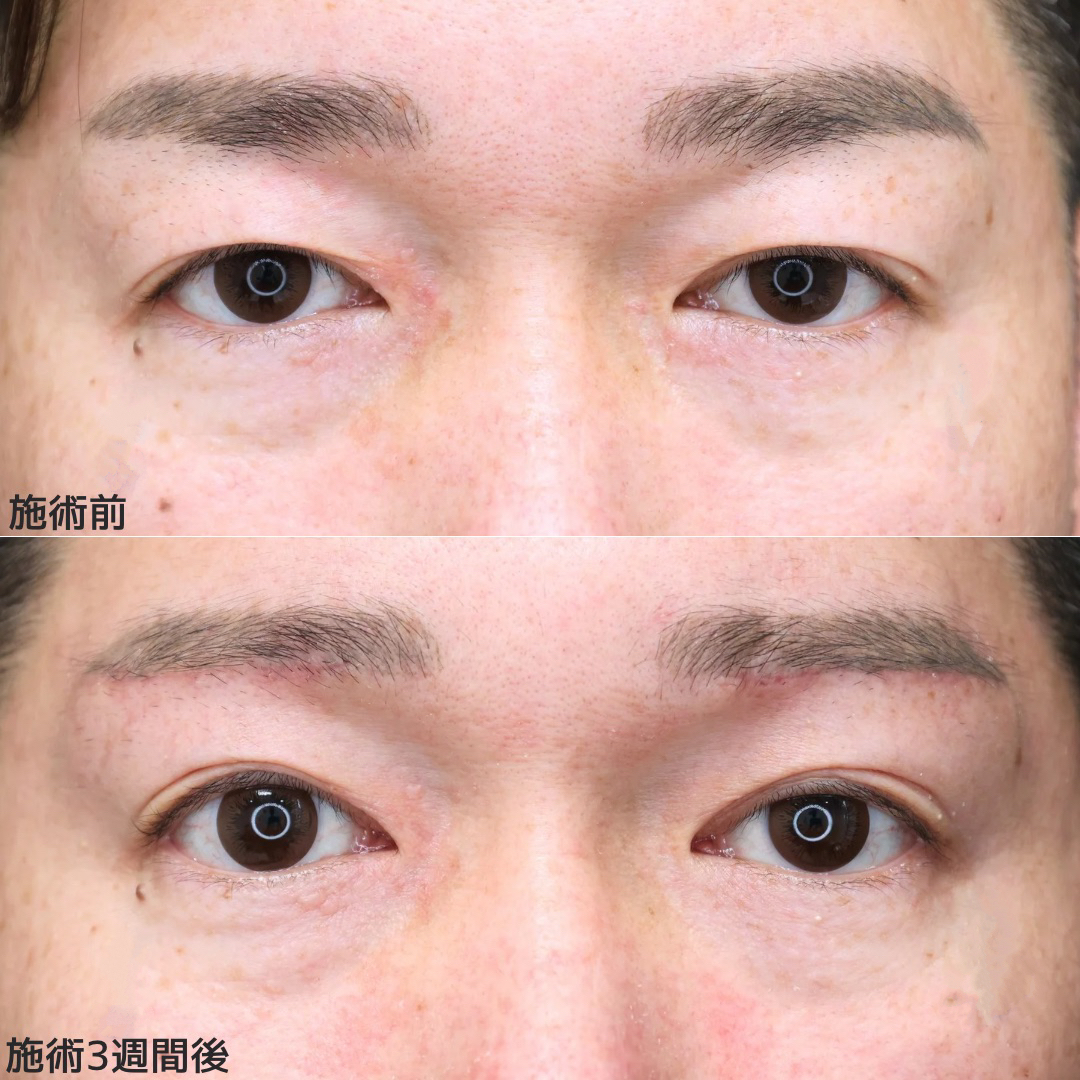 【眉下切開術】目の上のたるみ改善！メンズ若返り術