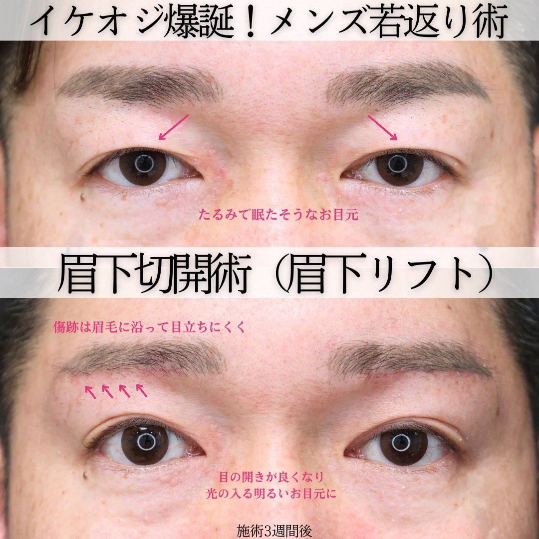 眉毛下切開術の症例写真 施術前後 