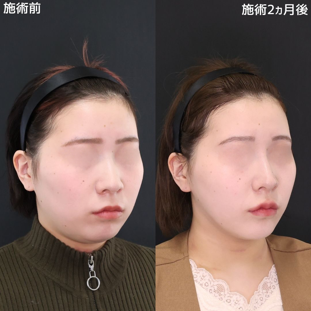 【糸リフト×脂肪除去】フェイスラインくっきり小顔術