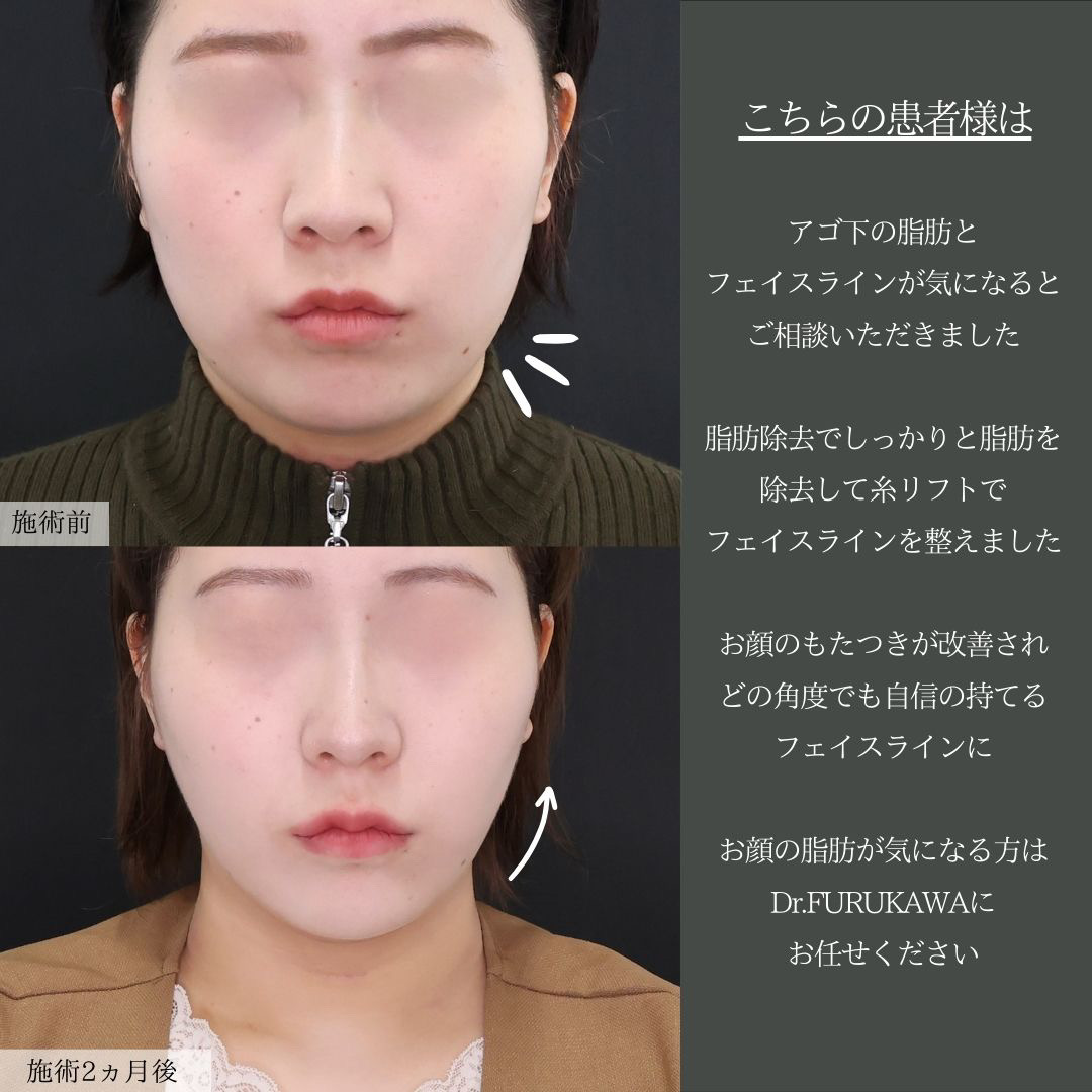 TAC式 ツヤ肌コラーゲンリフト®/ジョールファット除去/Lラインファット除去（エラ下脂肪除去）の症例写真 施術前後 