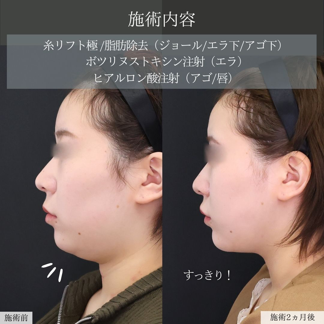 TAC式 ツヤ肌コラーゲンリフト®/ジョールファット除去/Lラインファット除去（エラ下脂肪除去）の症例写真 施術前後 