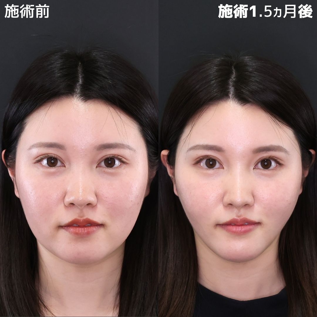 【糸リフト×脂肪除去】無加工で盛れる古川流小顔術
