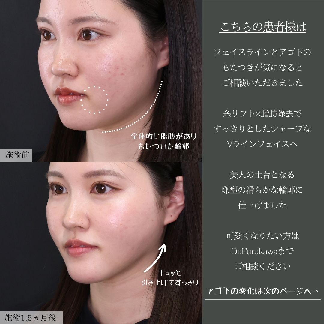 ジョールファット除去/Lラインファット除去（エラ下脂肪除去）/顔の脂肪吸引の症例写真 施術前後 