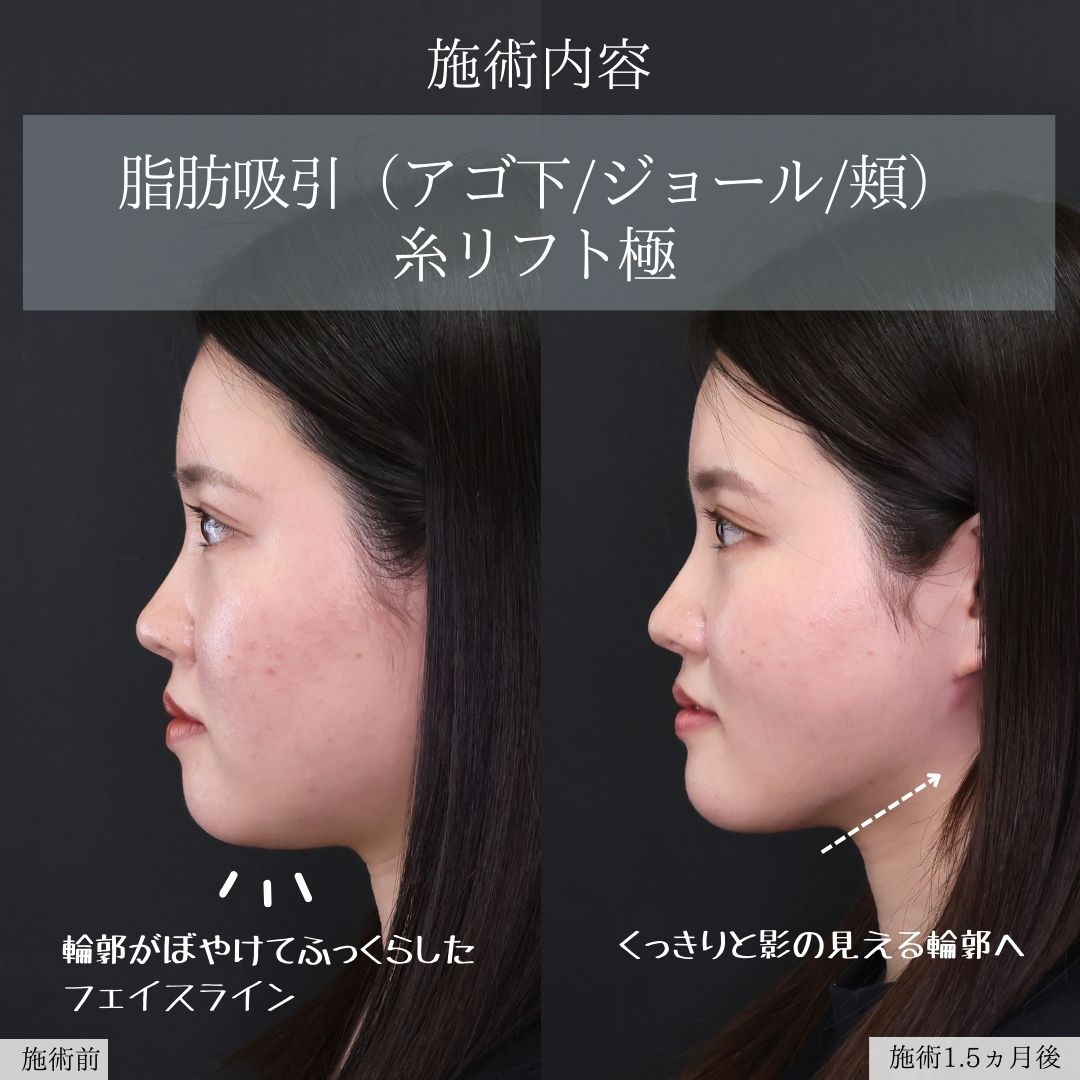 ジョールファット除去/Lラインファット除去（エラ下脂肪除去）/顔の脂肪吸引の症例写真 施術前後 