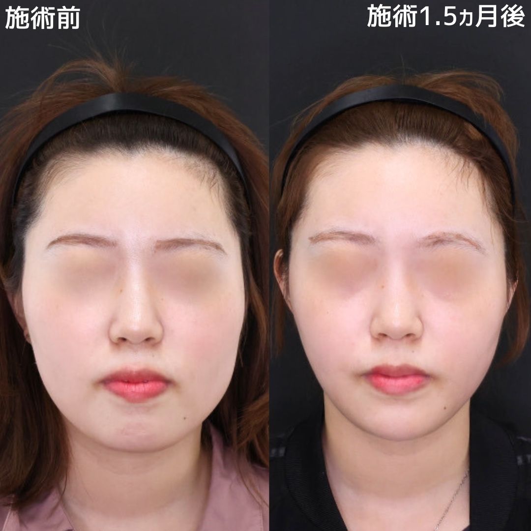 【脂肪除去×糸リフト】理想の卵型フェイスラインへ