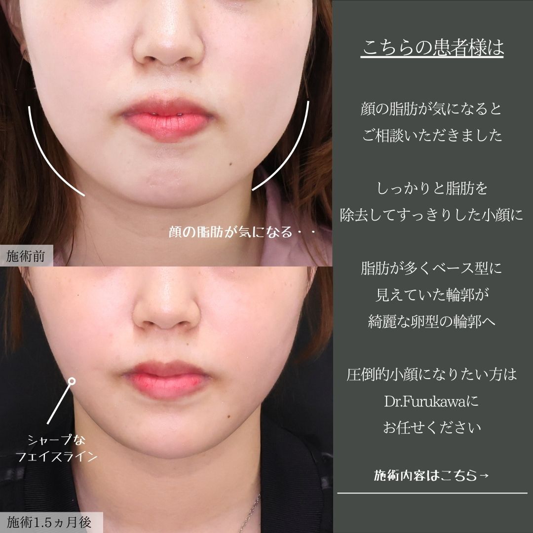 TAC式 ツヤ肌コラーゲンリフト®/顔の脂肪吸引/顎のヒアルロン酸注射の症例写真 施術前後 