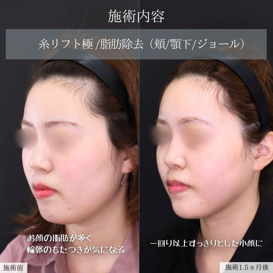 TAC式 ツヤ肌コラーゲンリフト®/顔の脂肪吸引/顎のヒアルロン酸注射の症例写真 施術前後 