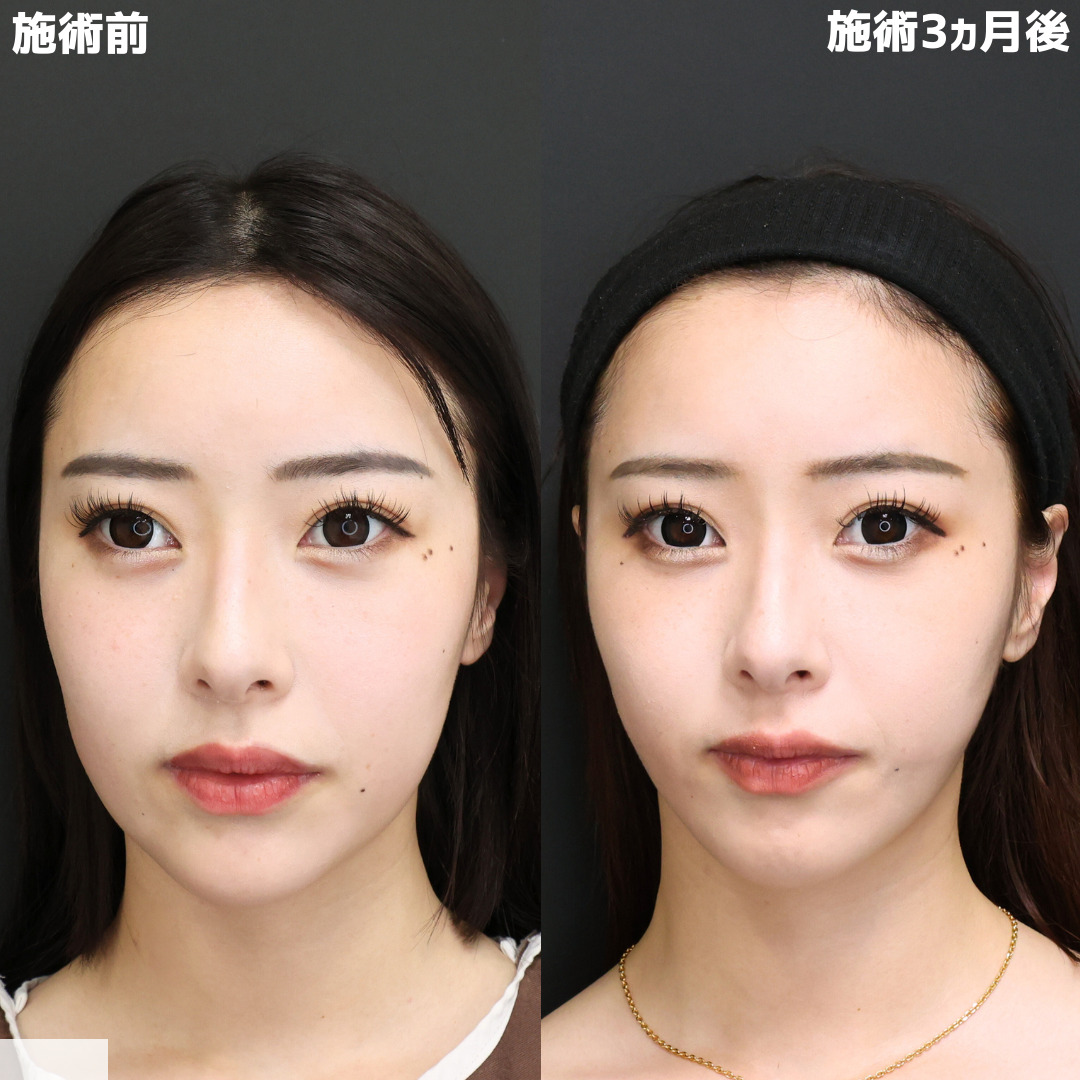 【脂肪除去×糸リフト】中顔面短縮で美人度UP！