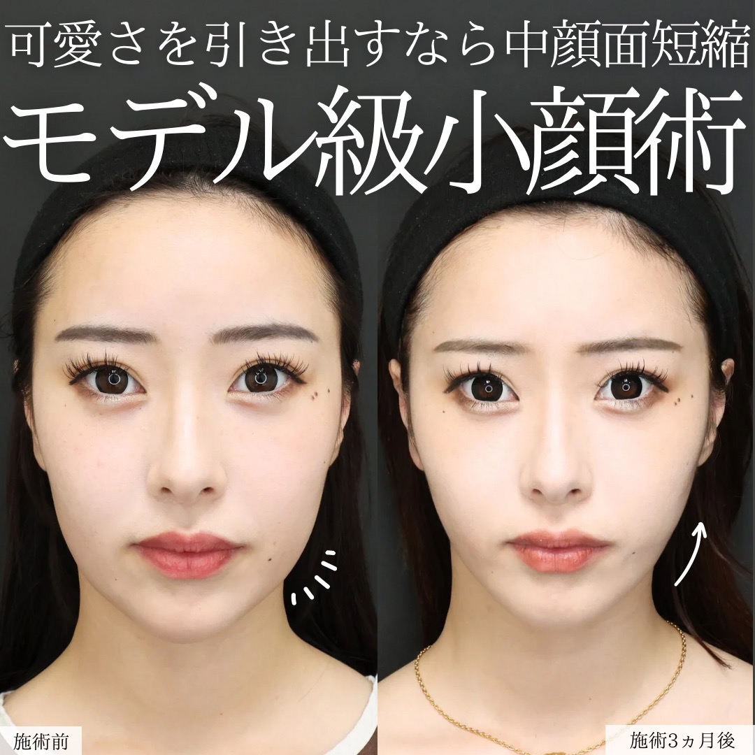 TAC式 ツヤ肌コラーゲンリフト®/ジョールファット除去/顎下の脂肪吸引の症例写真 施術前後 