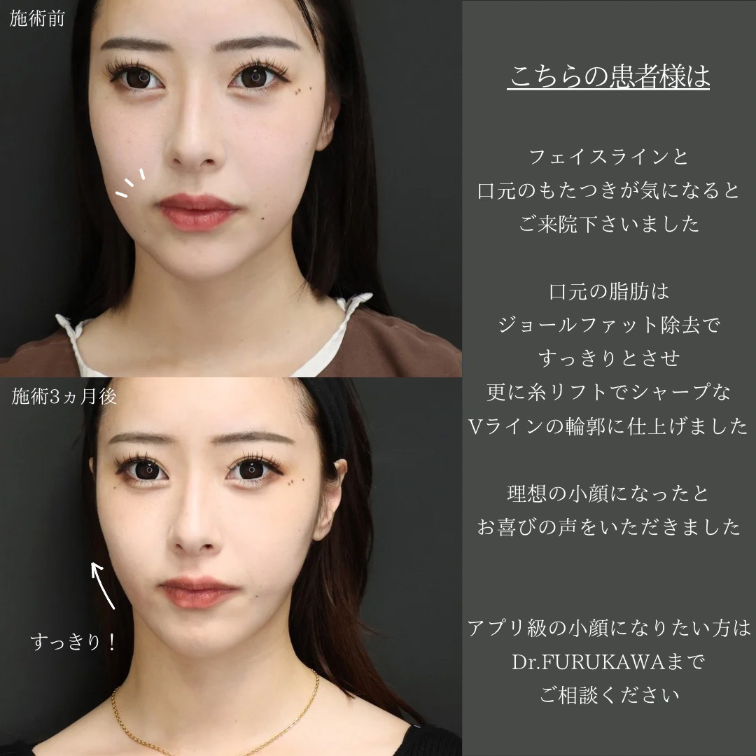 TAC式 ツヤ肌コラーゲンリフト®/ジョールファット除去/顎下の脂肪吸引の症例写真 施術前後 
