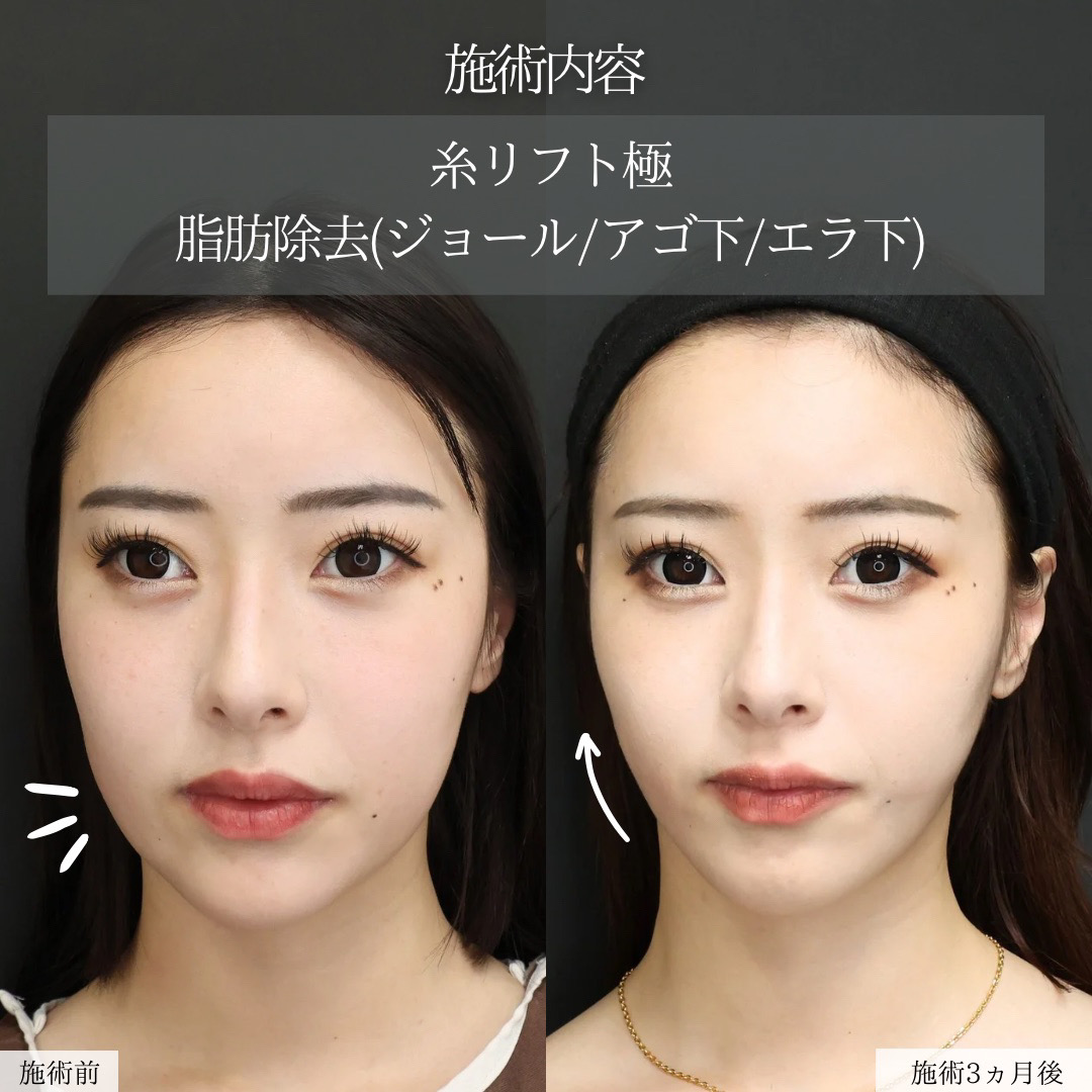 TAC式 ツヤ肌コラーゲンリフト®/ジョールファット除去/顎下の脂肪吸引の症例写真 施術前後 
