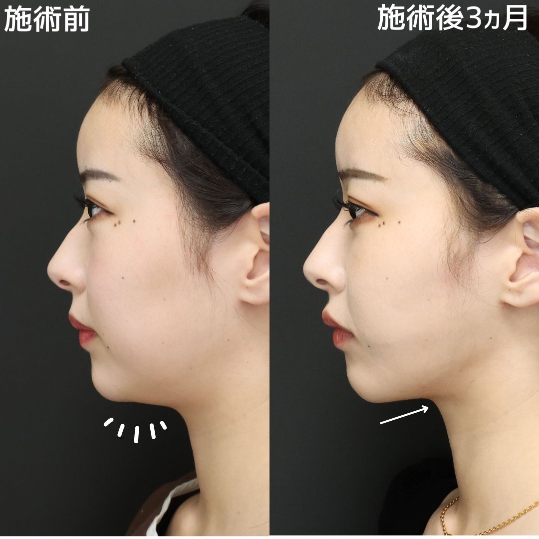TAC式 ツヤ肌コラーゲンリフト®/ジョールファット除去/顎下の脂肪吸引の症例写真 施術前後 