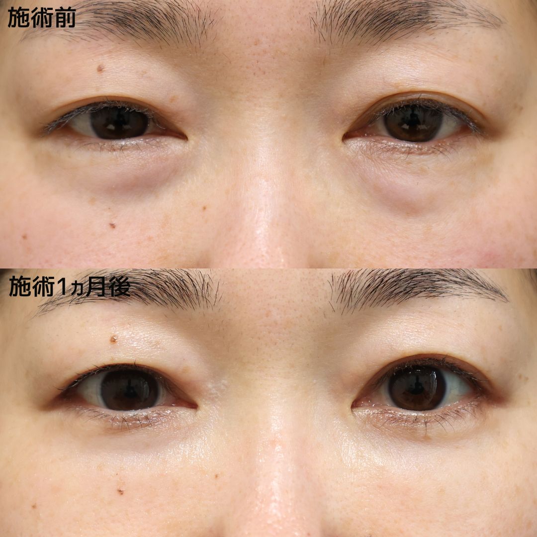 【くまとり×脂肪注入】目元すっきりで若々しい印象へ