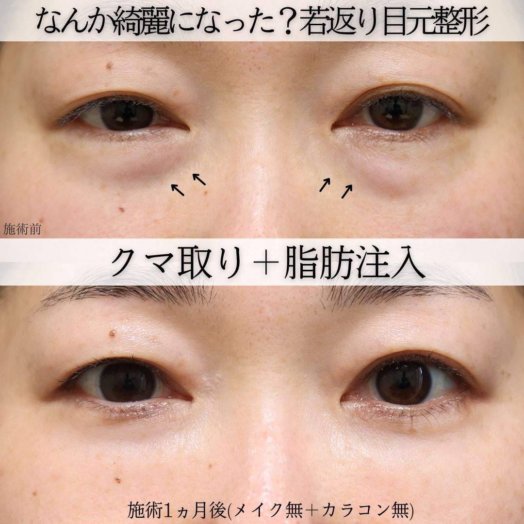 下眼瞼脱脂術（目の下のたるみ取り・目の下の脂肪ふくらみ取り）/顔の脂肪注入(コンデンスリッチフェイス)の症例写真 施術前後 