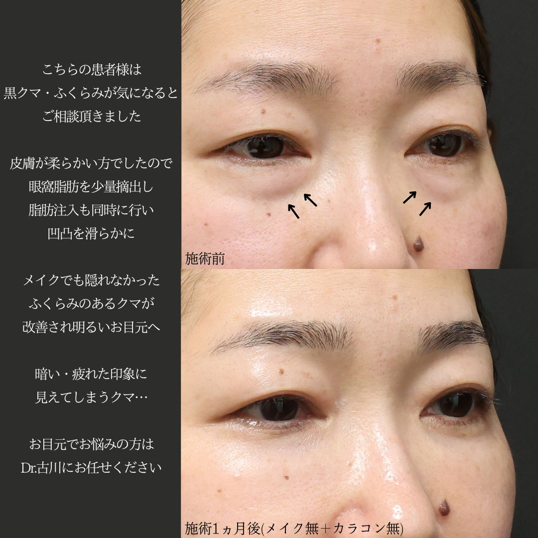 下眼瞼脱脂術（目の下のたるみ取り・目の下の脂肪ふくらみ取り）/顔の脂肪注入(コンデンスリッチフェイス)の症例写真 施術前後 