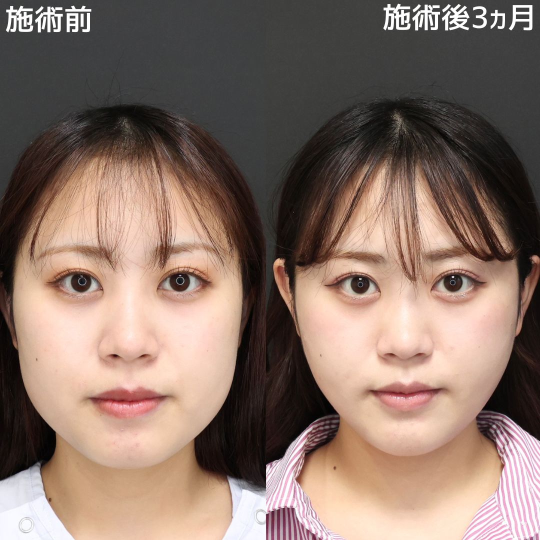 【糸リフト×脂肪除去】お顔の余白を無くして別人級の小顔に