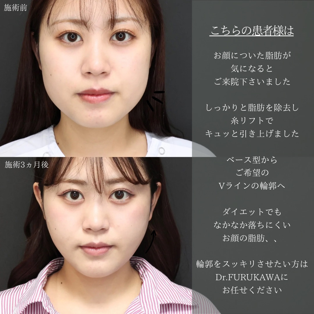 顔の脂肪吸引/ジョールファット除去/Lラインファット除去（エラ下脂肪除去）の症例写真 施術前後 