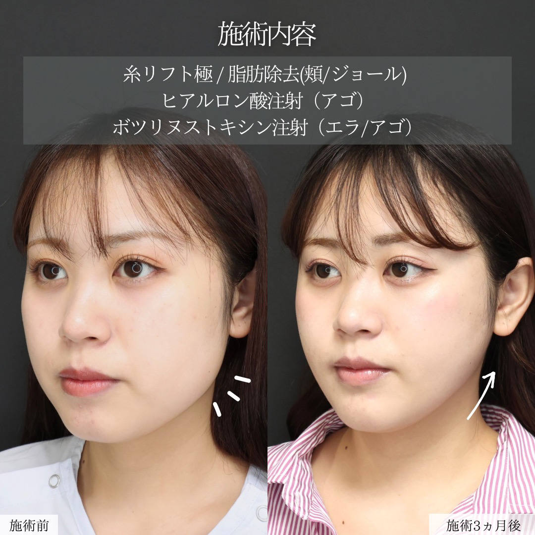 顔の脂肪吸引/ジョールファット除去/Lラインファット除去（エラ下脂肪除去）の症例写真 施術前後 