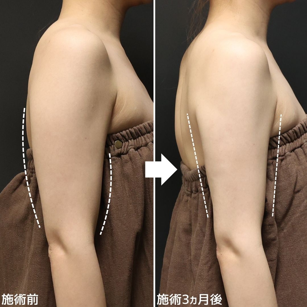 体の脂肪吸引の症例写真 施術前後 