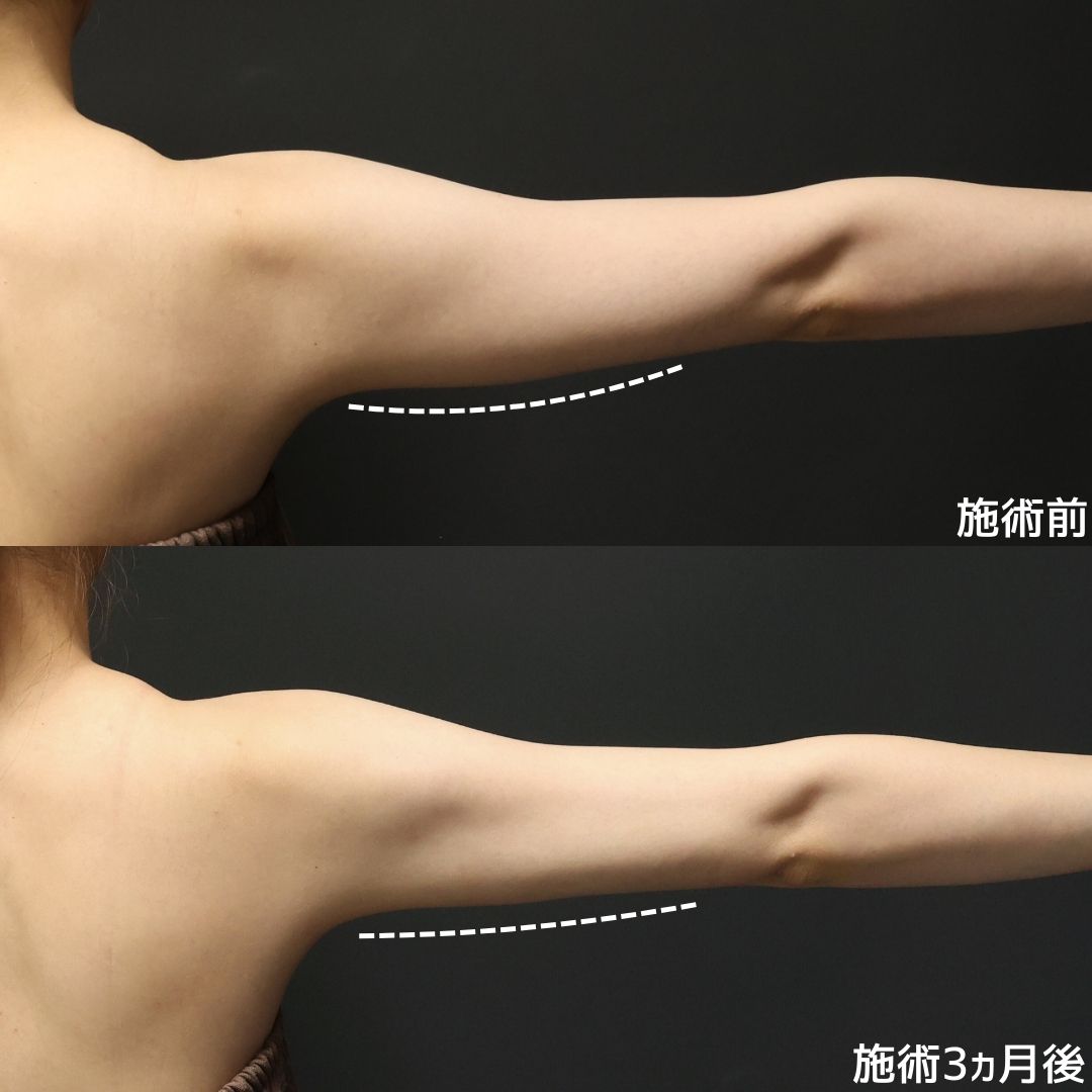 体の脂肪吸引の症例写真 施術前後 