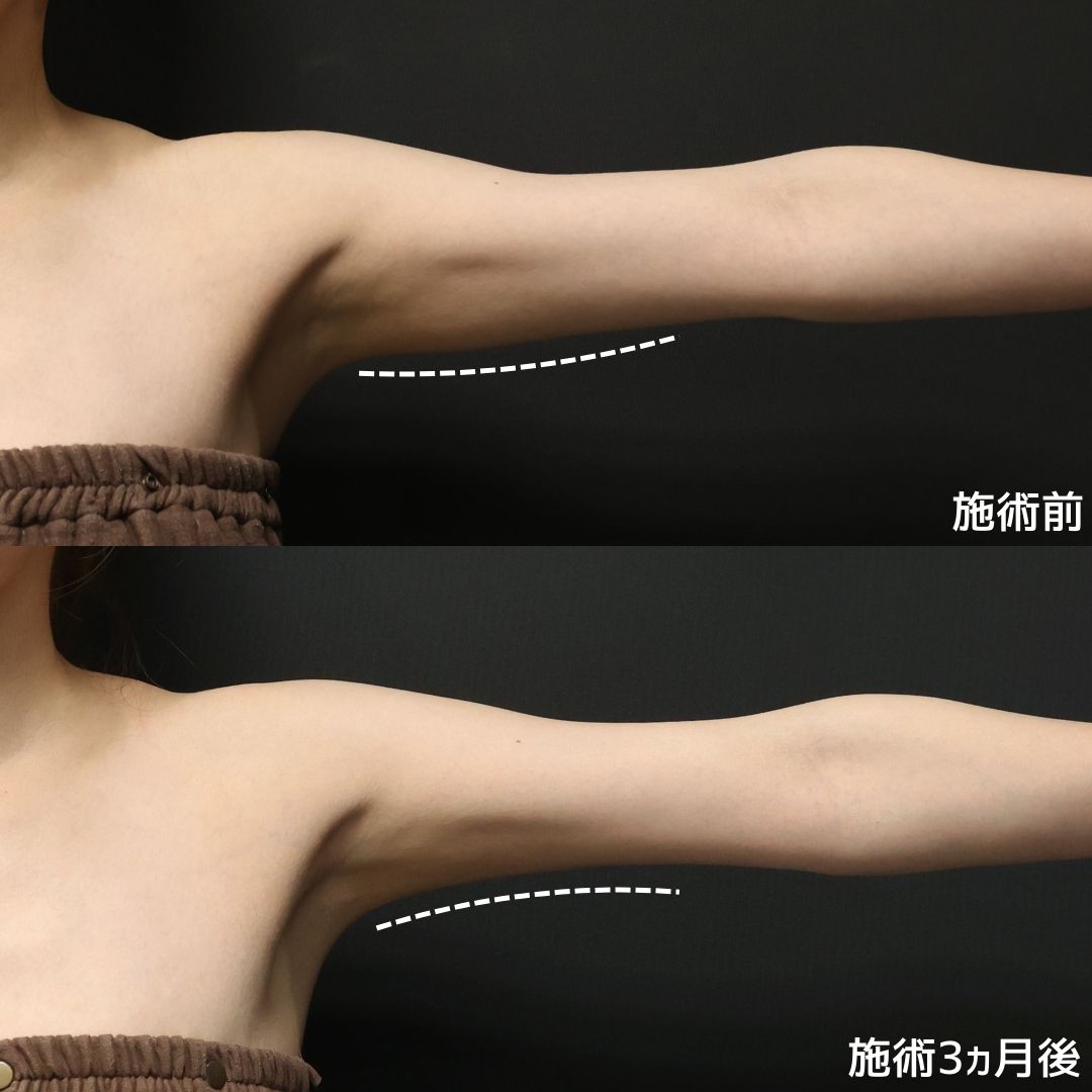 体の脂肪吸引の症例写真 施術前後 