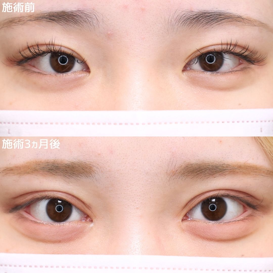 【二重切開×目頭切開】目の開き改善!垢抜けた平行二重へ