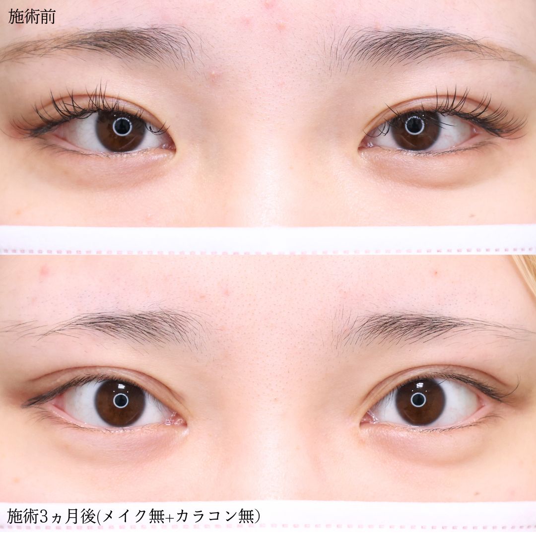 上眼瞼切開術/目頭切開術の症例写真 施術前後 