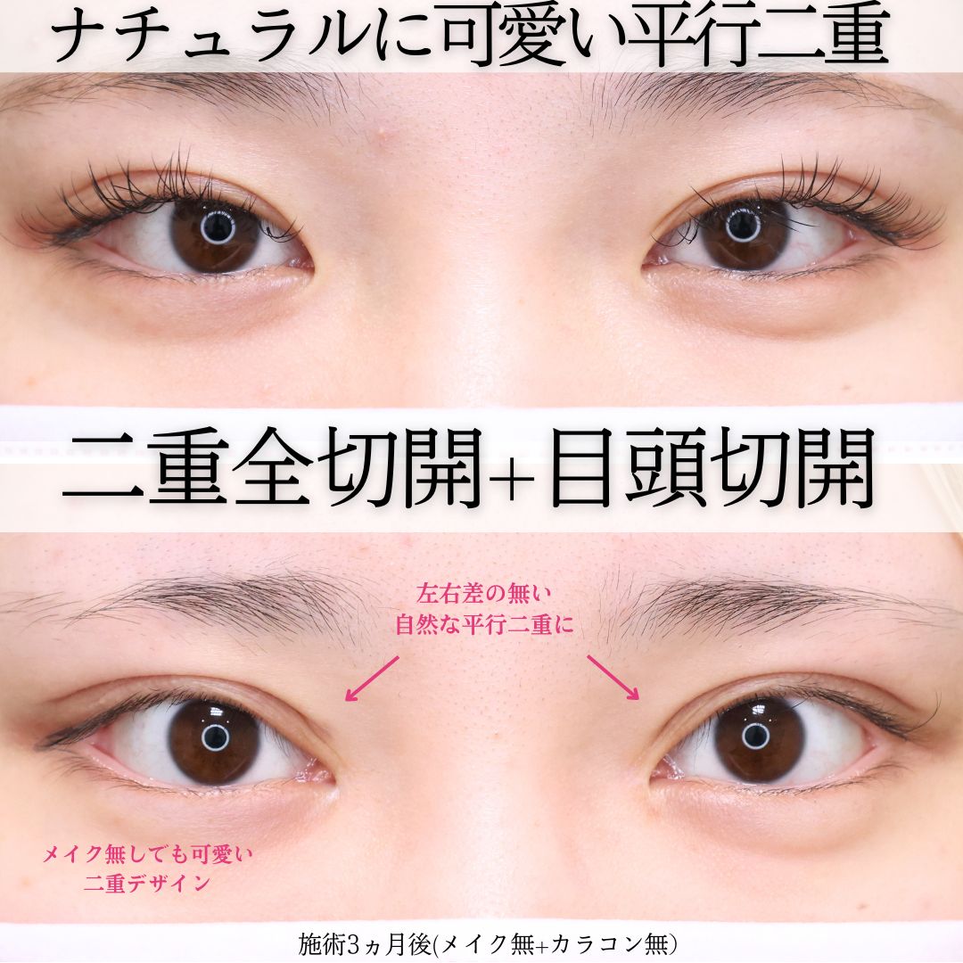 上眼瞼切開術/目頭切開術の症例写真 施術前後 