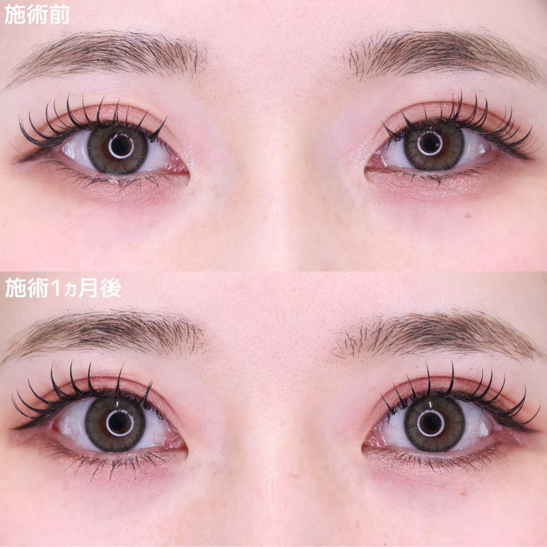 【タレ目形成×目尻切開】無加工でも盛れるデカ目整形