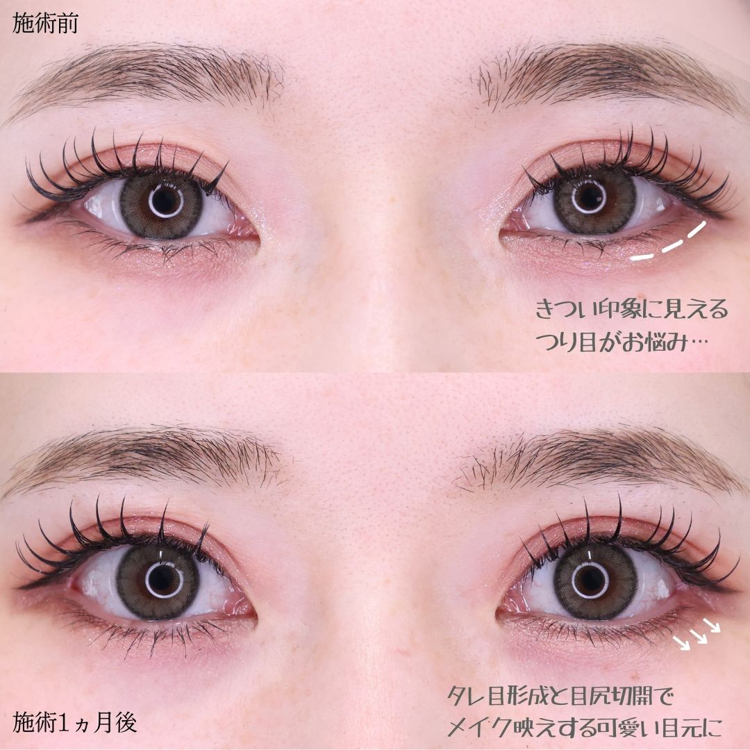 グラマラスライン（タレ目形成）/目尻切開術の症例写真 施術前後 